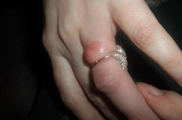 В Красноярском крае спасатели сняли кольцо с распухшего пальца 
